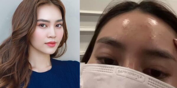 Ninh Dương Lan Ngọc đăng ảnh trán chi chít mụn